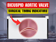 Bicuspid Aortic Valves: Key Indicators for Timing Surgery
