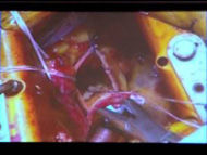 Sizing A Heart Valve Replacement (Dallas-Leipzig Valve Conference)