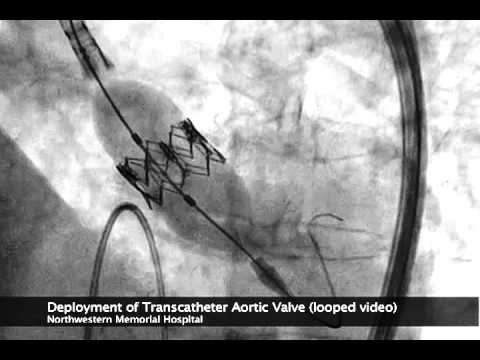 SAPIEN TAVR Deployment Under Flouroscopy (Ultrasound)