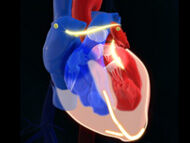 Atrial Fibrillation: A Big Risk for Patients?