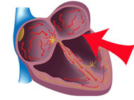 Should Atrial Fibrillation Be Treated During Mitral & Tricuspid Valve Surgery?