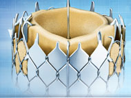 The BELIEVERS Clinical Trial to Evaluate TAVR for Bicuspid Aortic Valve Patients