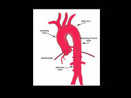 Surgeon Q&A: Minimally Invasive Aortic Valve & Aneurysm Surgery with Dr. Richard Shemin