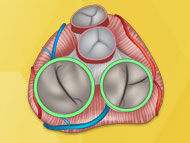 Mitral & Tricuspid Valve Surgery: Survival, Durability & Patient Outcomes