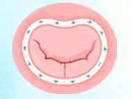 Patient Webinar: Advances in Heart Valve Repair