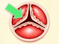 Patient Webinar: Long-Term Heart Valve Success