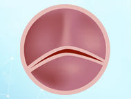 Patient Webinar:  Advances in Bicuspid Aortic Valve Therapy