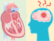 Surgeon Q&A: Does Mitral Regurgitation Cause Stroke?
