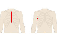 Mitral Valve Repair: Different Surgery Approaches (Sternotomy, MiniSternotomy and Robotic)