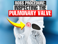 Ross Procedure Insights: Inspecting the Pulmonary Valve