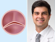 Bicuspid Aortic Valve: SAVR or TAVR?