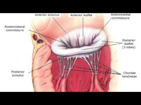 Patient Question: What Is Systolic Anterior Motion of The Chordae?