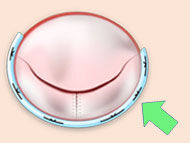 Surgeon Q&A: How Is Mitral Valve Disease Treated with Dr. Joanna Chikwe