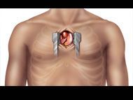 Patient Question: Is Minimally Invasive Heart Valve Surgery Less Painful?