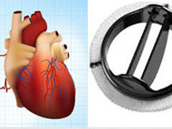 Will A Mitral Valve Repair or Replacement Fix My Atrial Fibrillation?