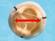 Patient Prosthesis Mismatch: How To Avoid It?