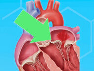 Surgeon Insights: Will I Need Mitral Valve Surgery?