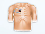 Surgeon Q&A: Minimally-Invasive Congenital Heart Valve Surgery