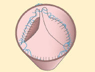 Ozaki Procedure: What Should Patients Know?