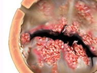 Does One Heart Valve Surgery Lead To Another Surgery?
