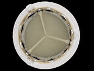 Cardiology Innovations: Transcatheter Mitral Valve Re-Operations
