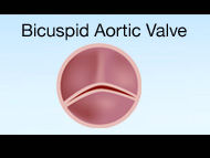 New Approach To Bicuspid Aortic Valve Disease Treatment with Dr. Patrick McCarthy, MD