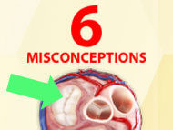 Patient Webinar: 6 Misconceptions of Heart Valve Surgery