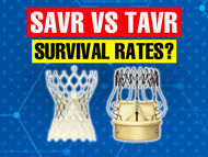 Surgical Versus Transcatheter Aortic Valve Replacement Survival in Patients Over 65 Years Old