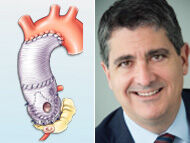 Surgeon Q&A: Advantages of Valve-Sparing Procedures for Bicuspid Aortic Valves