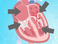 Doctor Q&A: Complex Mitral Valve Surgery with Dr. Wilson Szeto
