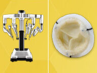 Heart Surgery Innovation: Robotic Mitral Valve Replacement