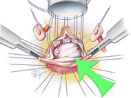 Surgeon Q&A: Modified David Reimplantation Procedure