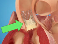 5 Must-Know Facts About TAVR for Aortic Valve Patients