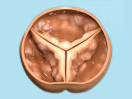 Aortic Valve Stenosis: Symptoms, Risks & Treatment