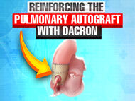 Reinforcing the Pulmonary Autograft with Dacron During the Ross Procedure