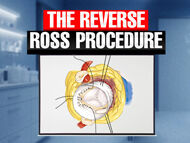 Cardiac Innovation: The Reverse Ross Procedure