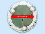 Medical Innovation: The Y-Incision Annulus Enlargement Procedure