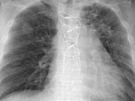 Sternum Wires:  Are They MRI Safe? Can Patients Get the Wires Removed?