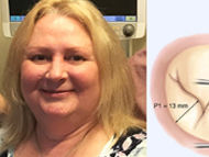 Mitral Valve Repair Success Story: Janet Ruddock
