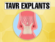 Surgeon Q&A: TAVR Explants & the Lifetime Management of Aortic Stenosis