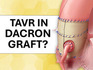 Is Transcatheter Aortic Valve Replacement (TAVR) Available to Patients with a Dacron Graft?