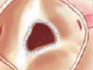 Unicuspid Aortic Valve: A Rare But Serious Valve Defect