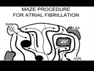 Surgeon Q&A: Concomitant Mitral Regurgitation & Atrial Fibrillation Surgery with Dr. Harold Roberts