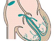 Atrioventricular Block After Heart Surgery:  What Should Patients Know?