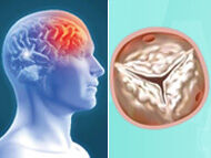 Surgeon Q&A: Can Heart Valve Calcium Break Off And Cause a Stroke?