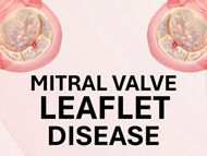 Thickened Mitral Valve Leaflets: What Should Patients Know?