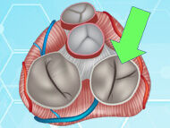 Medical Update: The Tricuspid Valve Is Not 