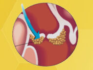 Bacterial Endocarditis: Top 9 Facts for Heart Valve Patients