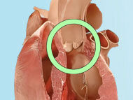 Surgeon Q&A: Will My Dilated Aortic Root Need Surgery?