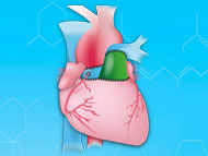 Ross Procedure Research: Life Expectancy & Reoperations